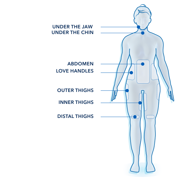 Figur som visar en kvinnokropp framifrån och vilka områden som kan behandlas med coolsculpting
