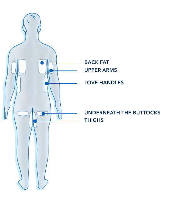 Figur som visar en manskropp bakifrån och vilka områden som kan behandlas med coolsculpting