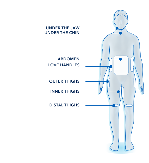 Figur som visar en manskropp framifrån och vilka områden som kan behandlas med coolsculpting