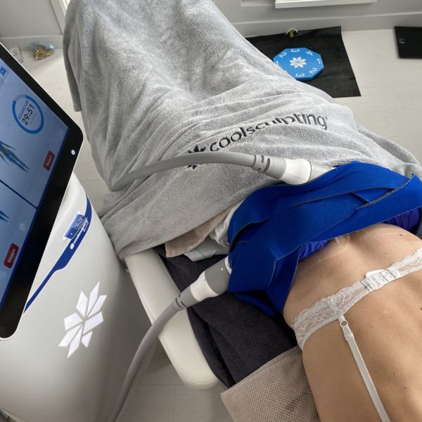 Person som genomgår CoolSculpting-behandling med kylanordning fäst på buken. En handduk täcker överkroppen.